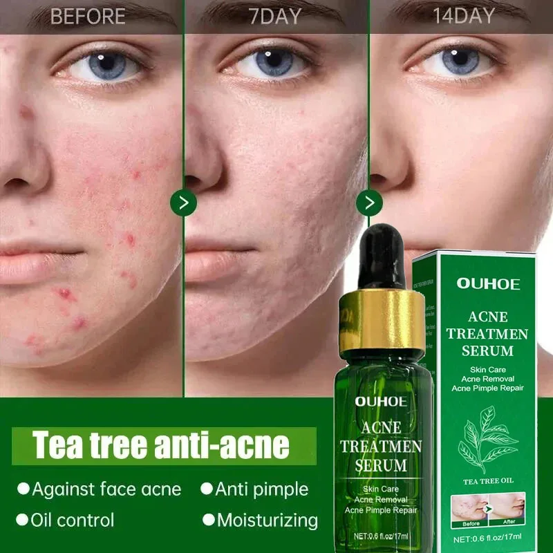 Alternative view of Acne Treatment Facial Serum Pore Shrinking Skin Care Against Face Acne Pimple Spots Remover Cleaning Shrink pores Tea Tree Serum