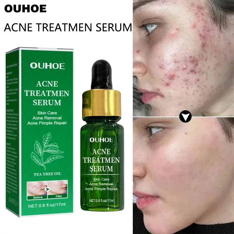 Acne Treatment Facial Serum Pore Shrinking Skin Care Against Face Acne Pimple Spots Remover Cleaning Shrink pores Tea Tree Serum Acne Treatment Facial Serum Pore Shrinking Skin Care Against Face Acne Pimple Spots Remover Cleaning Shrink pores Tea Tree Serum